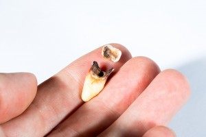 sonhar com dente podre sonhar com dente podre