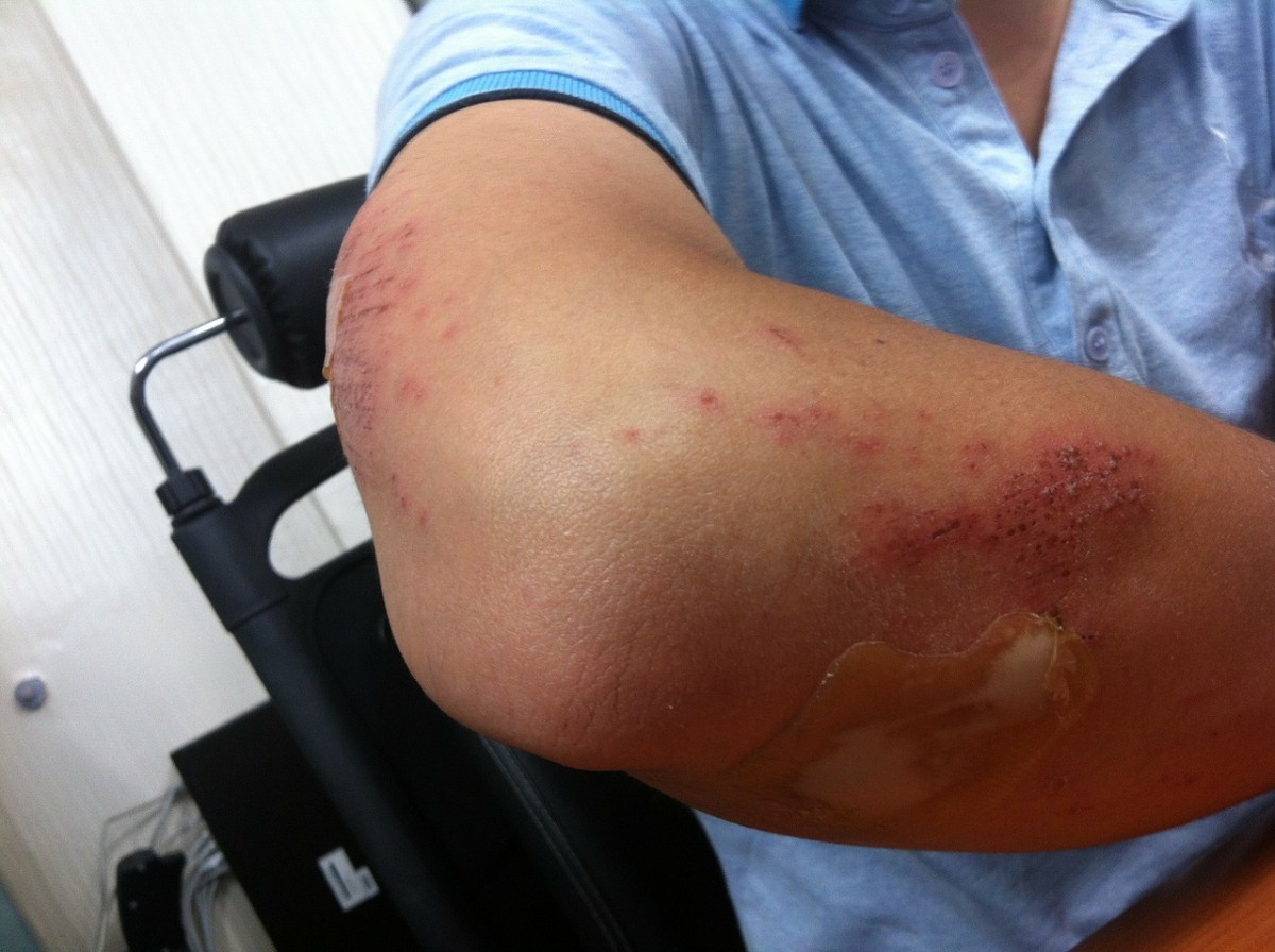 Sonhar com Hematoma o que significado sonhar com Hematoma