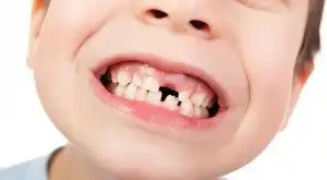 Featured image of post Sonhar Com Dente Mole Quando o sonho os dentes aparecem muito tortos ou muito moles um sinal de que voc est com sorte