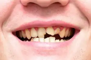 Featured image of post Dente Encavalado Feio Se o dente est inclinado ou angulado o br quete tamb m fica assim