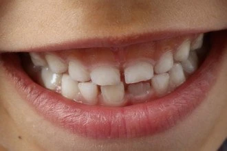 Criança sorrindo com dente mole